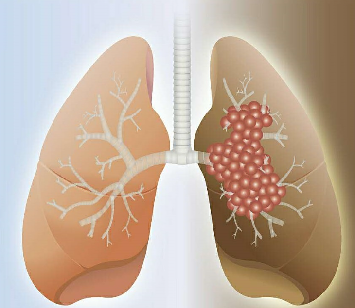 肺癌咳嗽出血如何用藥