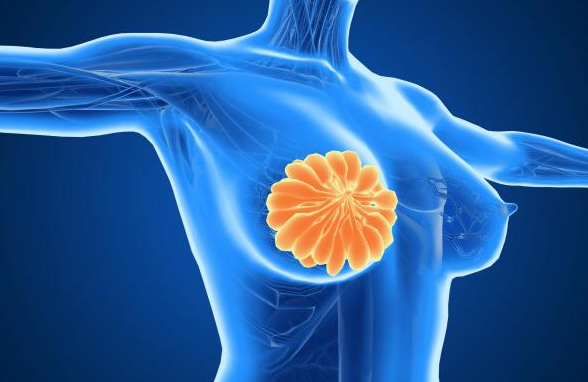 乳腺癌的發生與哪些關鍵因素息息相關