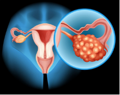卵巢癌晚期常見癥狀表現